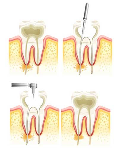 endodonzia Cenisia San Paolo Torino endodonzia Cenisia San Paolo Torino