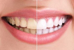 Igiene dentale e detartrasi Cenisia San Paolo Torino Igiene dentale e detartrasi Cenisia San Paolo Torino